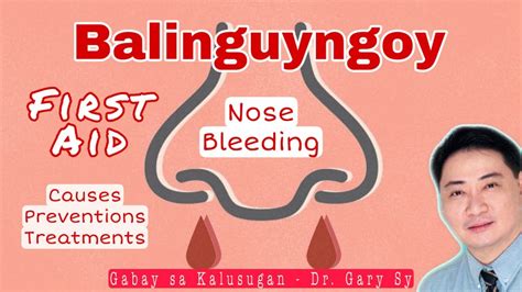 Balinguyngoy: Nose Bleeding (Epistaxis) .